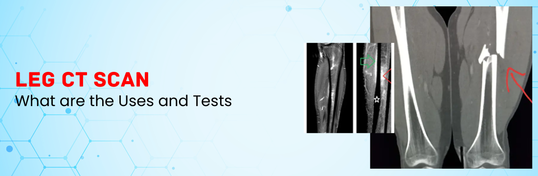 Leg CT Scan and Its Uses